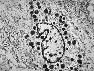 F,72y. | melanoblastoma oculi F,72y. | melanoblastoma oculi
